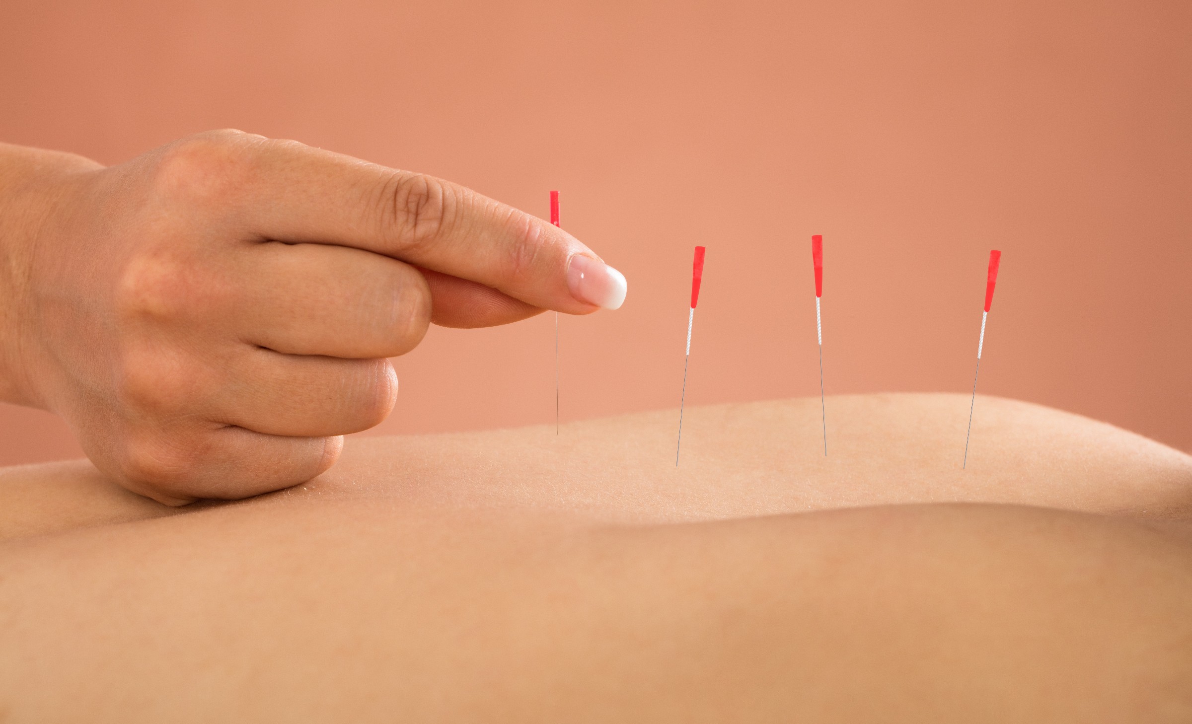 Acupuncture